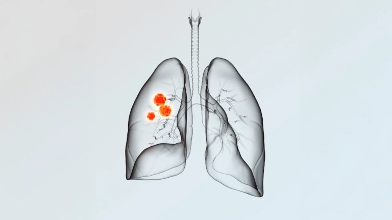New AI outlines lung tumors better and faster than doctors, study finds