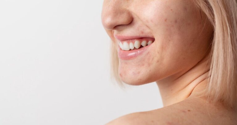 Clear skin solutions for Londoners: Exploring international options for acne treatment